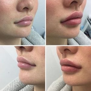 美の安全唇の増加の注入口の液体のゲルの化粧品の唇の注入