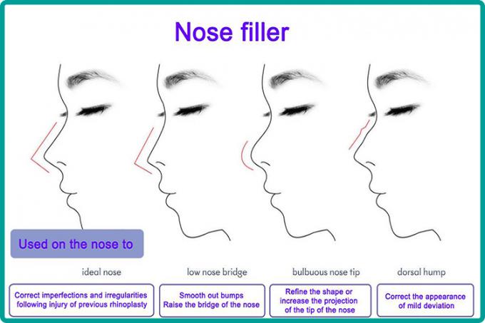 鼻の先端の訂正のHyaluronic酸の注入の安全診療所のレベル